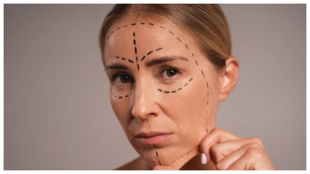 PDO Thread Lift San Jose