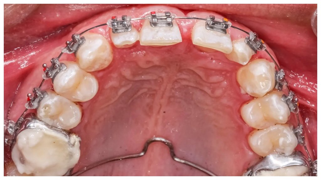Palatal Expander