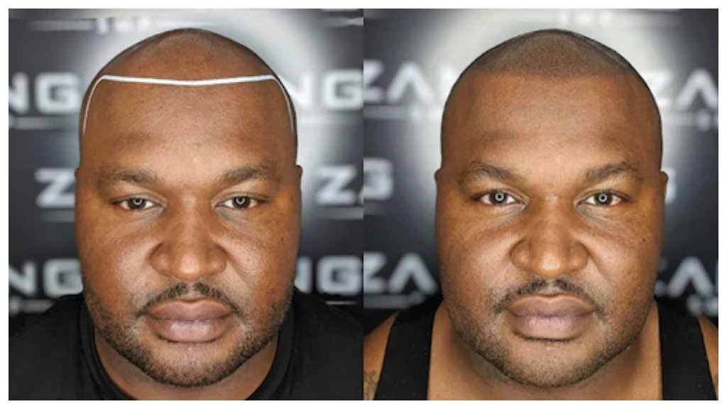 Scalp Micropigmentation Orange County