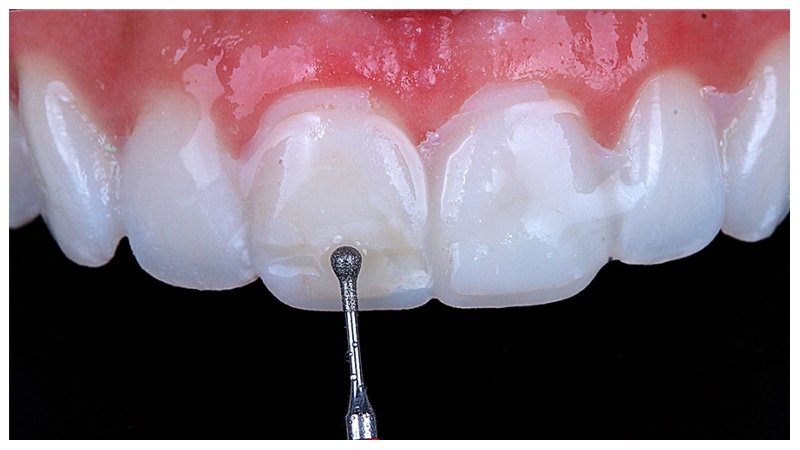ceramic veneers